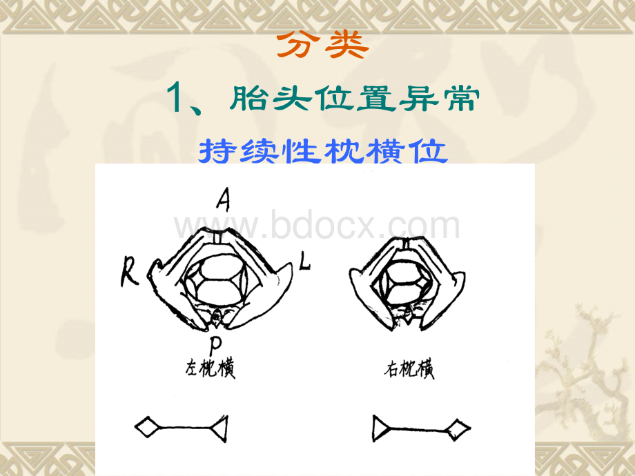 胎位异常.ppt_第2页