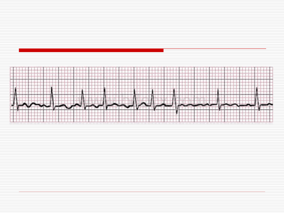 ECG-孙奇.ppt_第3页