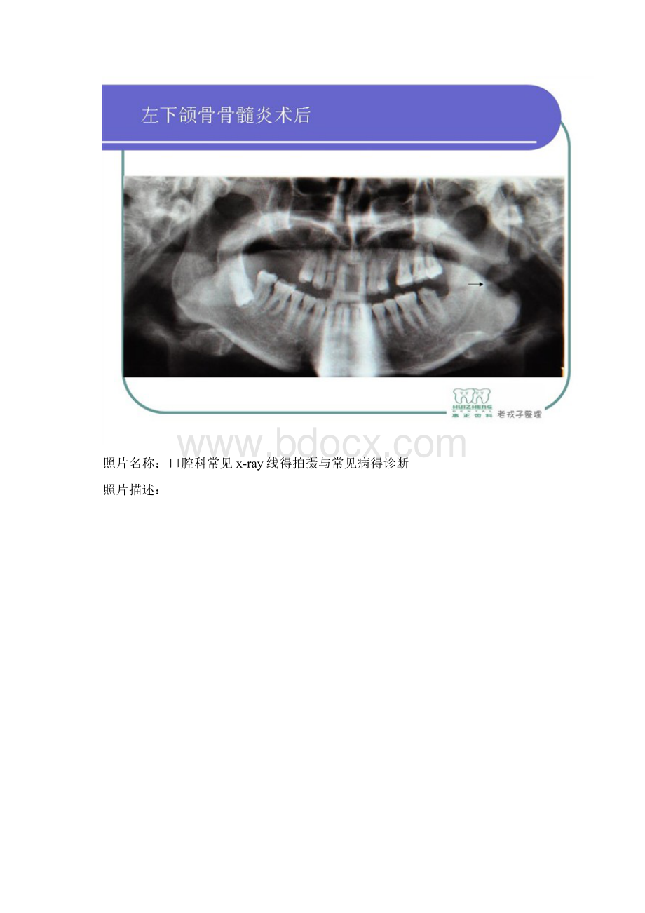 常见口腔X线判读及放射技术Word格式.docx_第3页