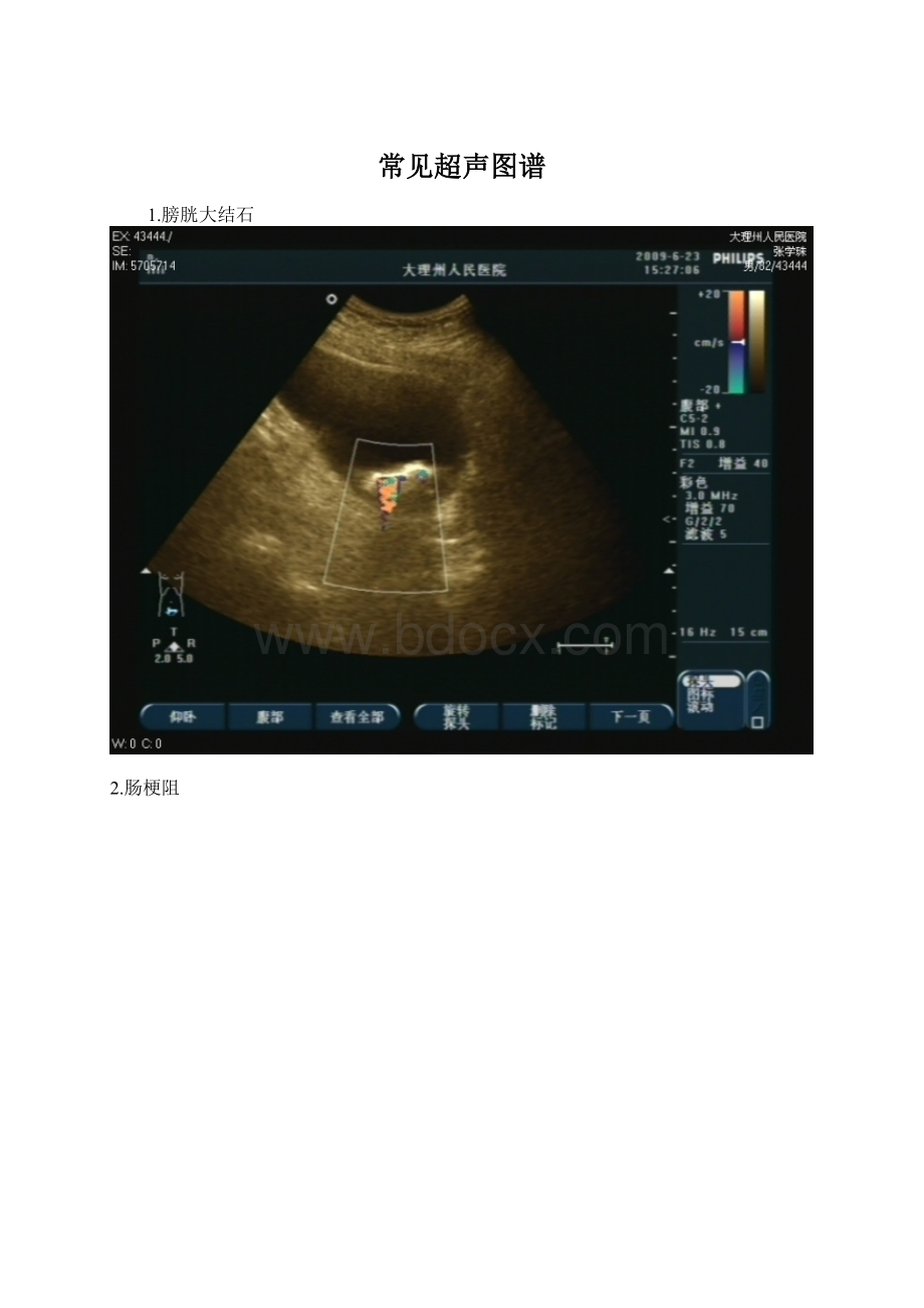 常见超声图谱Word文档下载推荐.docx_第1页