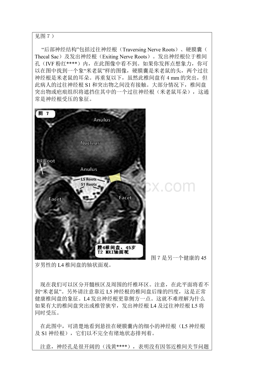 怎样看椎间盘CTMRI片影像FTPWord文档格式.docx_第3页