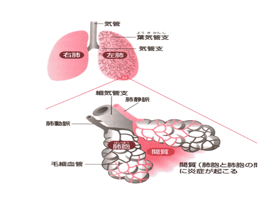 肺炎病人的护理PPT资料.ppt_第3页