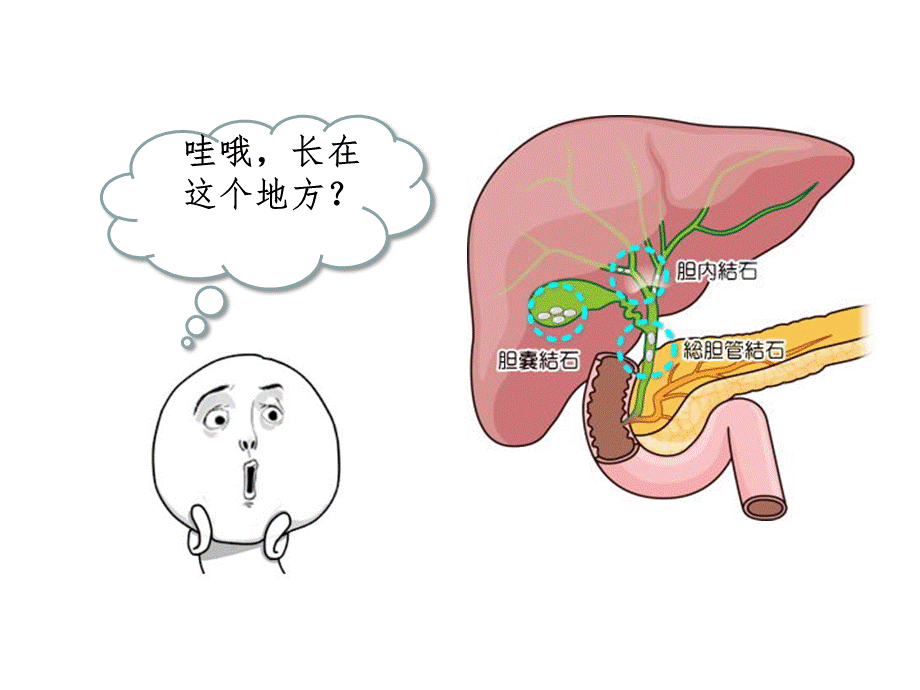 胆囊结石科普课件PPT课件下载推荐.ppt_第3页