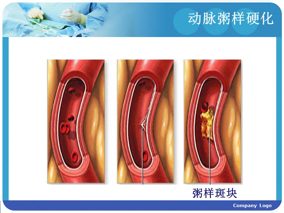 冠心病的护理PPT文档格式.ppt_第2页