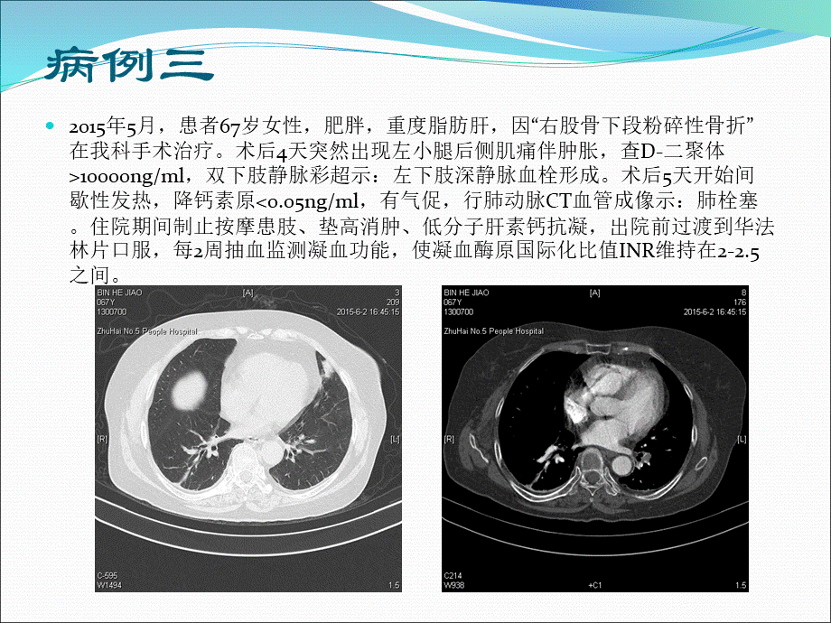 院内静脉血栓栓塞症的预防PPT文件格式下载.ppt_第3页