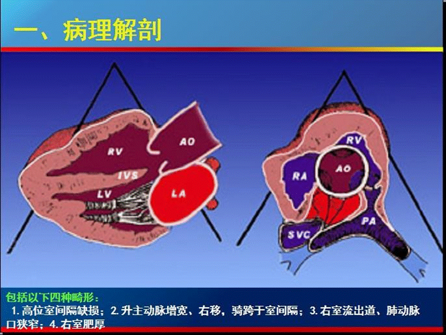 超声法洛四联症ppt课件.ppt_第3页