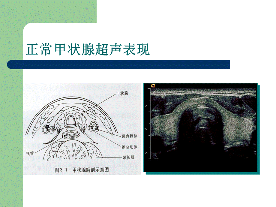 甲状腺与甲状旁腺PPT资料.ppt_第3页