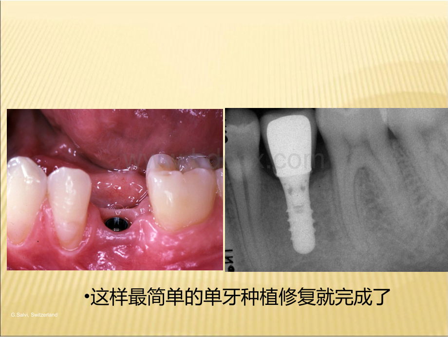 口腔种植术学案PPT资料.pptx_第3页