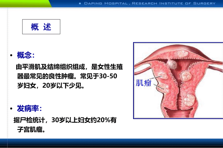 子宫肌瘤课件.PPTPPT格式课件下载.ppt_第2页