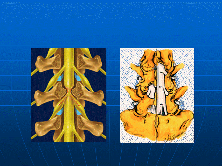 腰椎椎管狭窄症治疗的新方法.ppt_第2页