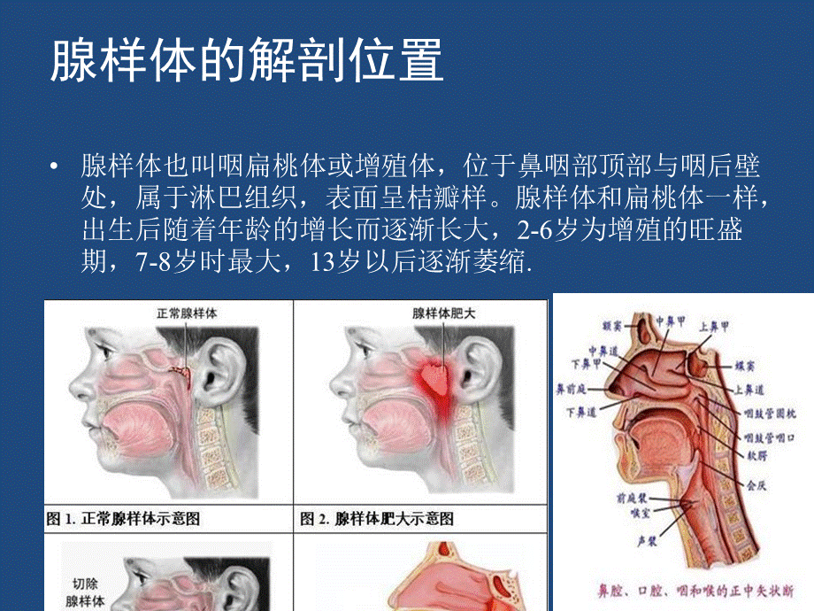 腺样体肥大患者护理查房PPT资料.pptx_第3页