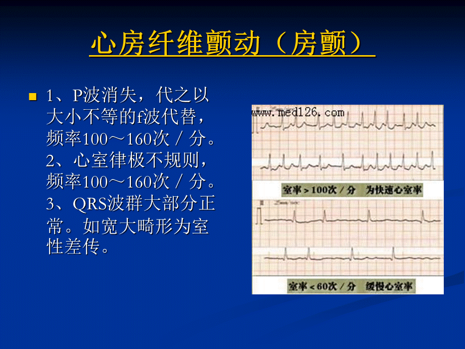 几种常见心电图表现PPT文件格式下载.ppt_第1页