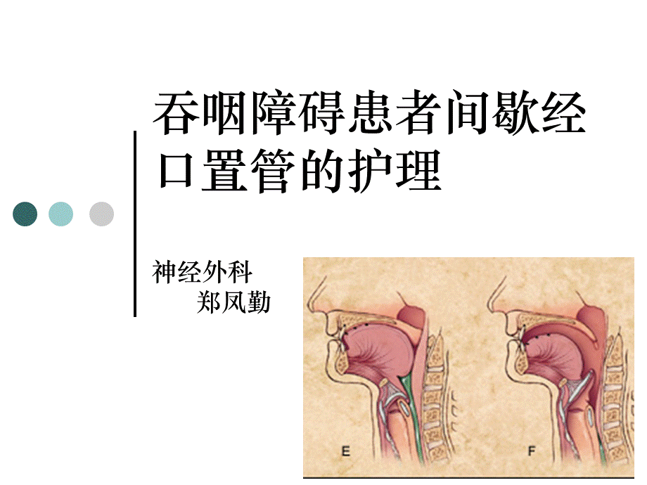 吞咽障碍护理.ppt_第1页