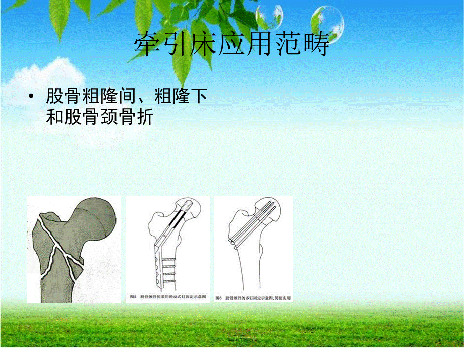 牵引床体位.ppt_第3页