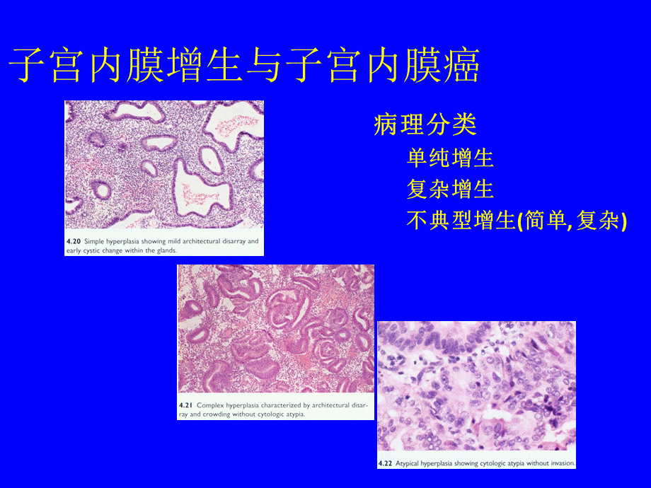 子宫内膜癌分型.ppt_第3页