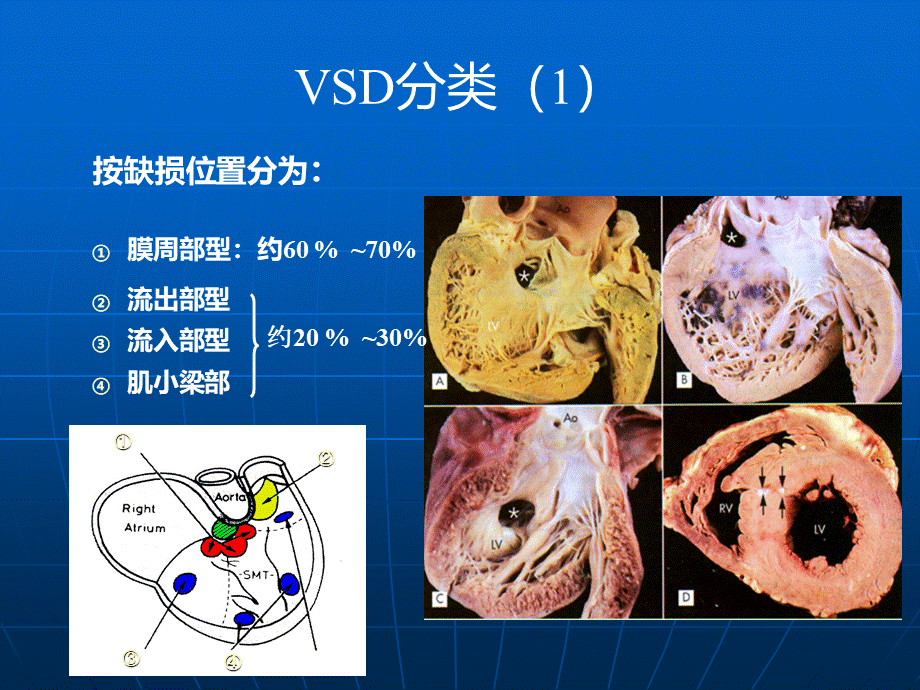 先天性心脏病.ppt_第3页