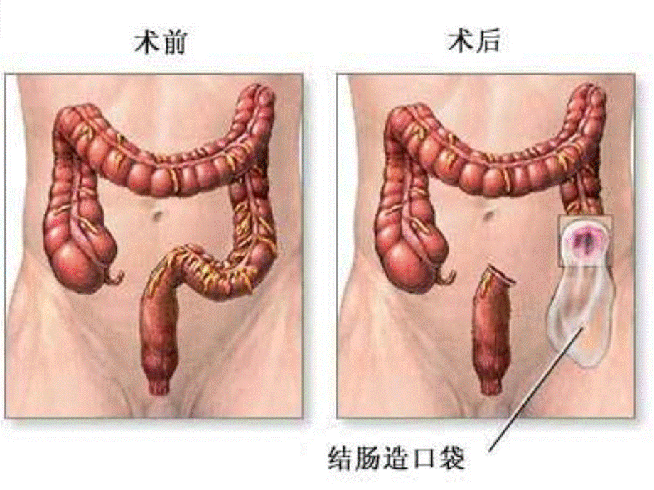 人工肛门的护理讲解学习.ppt_第3页