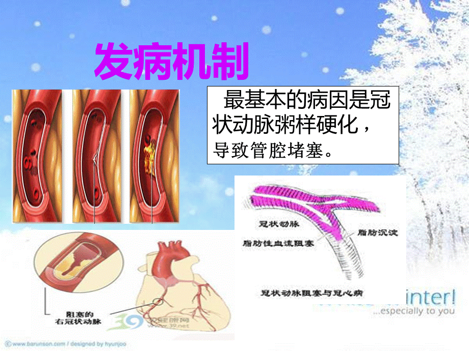 冠心病护理查房PPT课件下载推荐.ppt_第3页