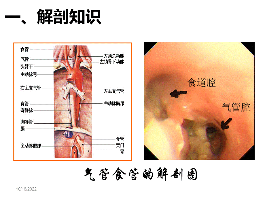 气管食管瘘PPT资料.ppt_第3页