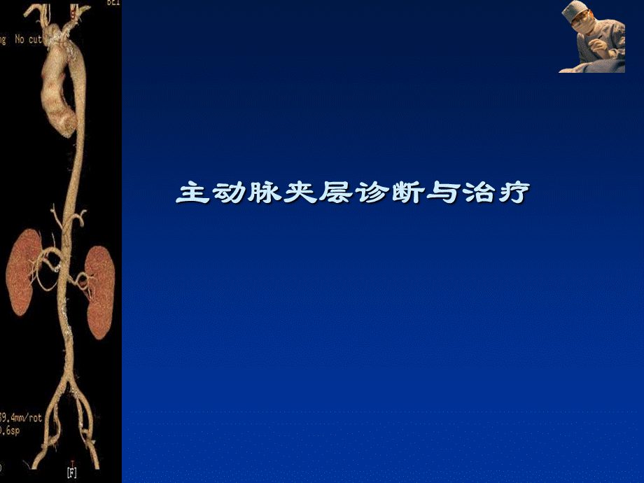 主动脉夹层诊断与治疗.ppt_第1页