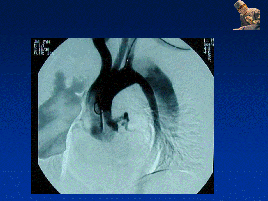 主动脉夹层诊断与治疗.ppt_第3页