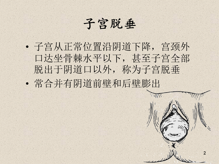 子宫脱垂病人的护理.ppt_第2页