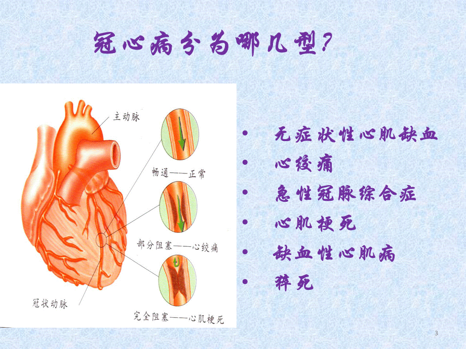 小讲课冠心病的课程课件.ppt_第3页