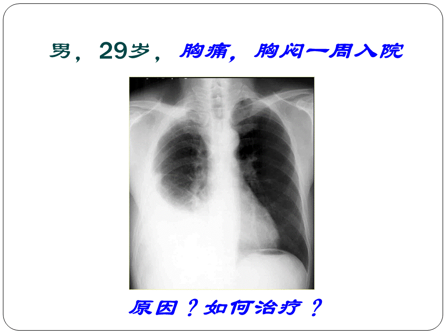 胸腔积液课件.ppt_第1页