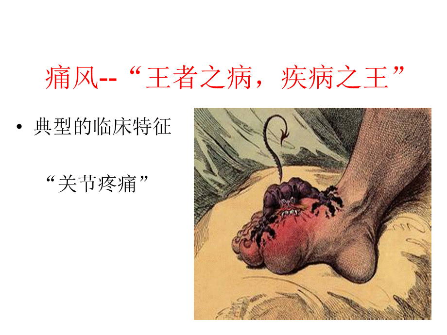 痛风讲课.ppt_第3页