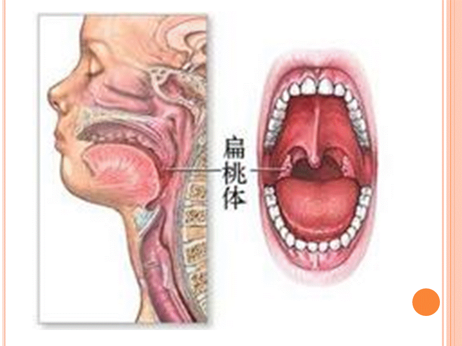 扁桃体炎.ppt_第2页