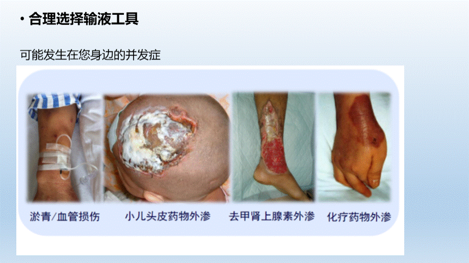 外周留置针操作要点解析课件PPT推荐.pptx_第3页