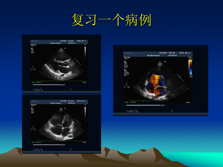 tee心脏解剖和常用切面李贵双.ppt_第3页