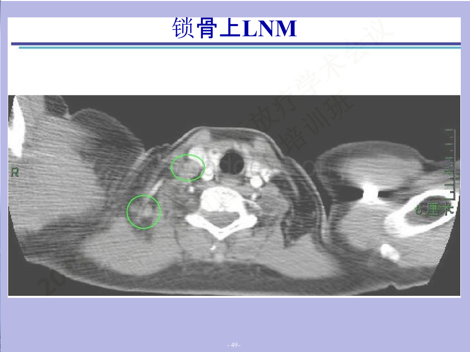 乳腺癌术后放疗淋巴引流区及正常组织勾画PPT资料.pptx_第3页