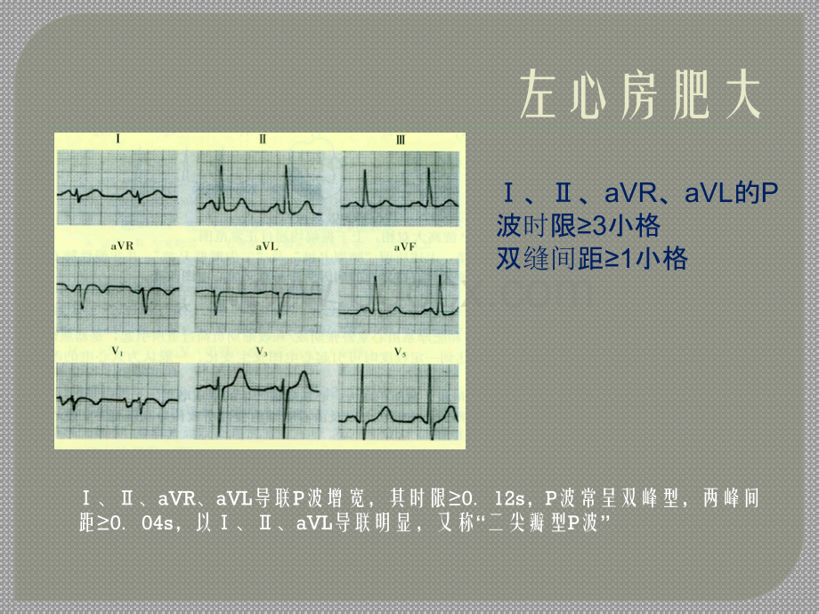 内科学诊断学重点心电图快速识图.ppt_第3页