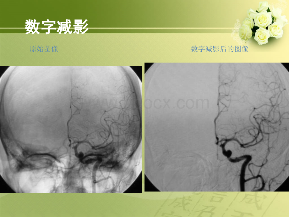 如何阅读脑血管DSA片PPT资料.ppt_第3页