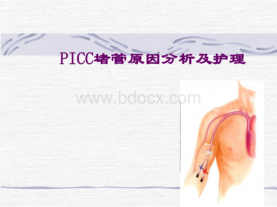 picc堵管原因分析及护理.ppt_第1页