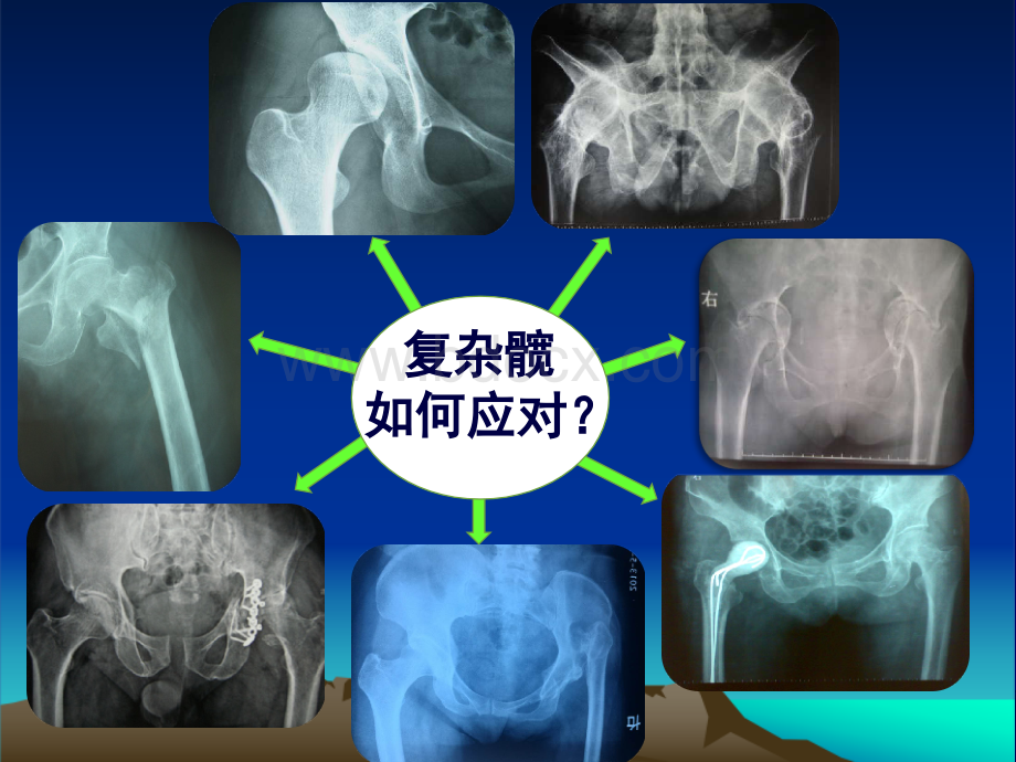 复杂性髋关节THA系列一.ppt_第3页