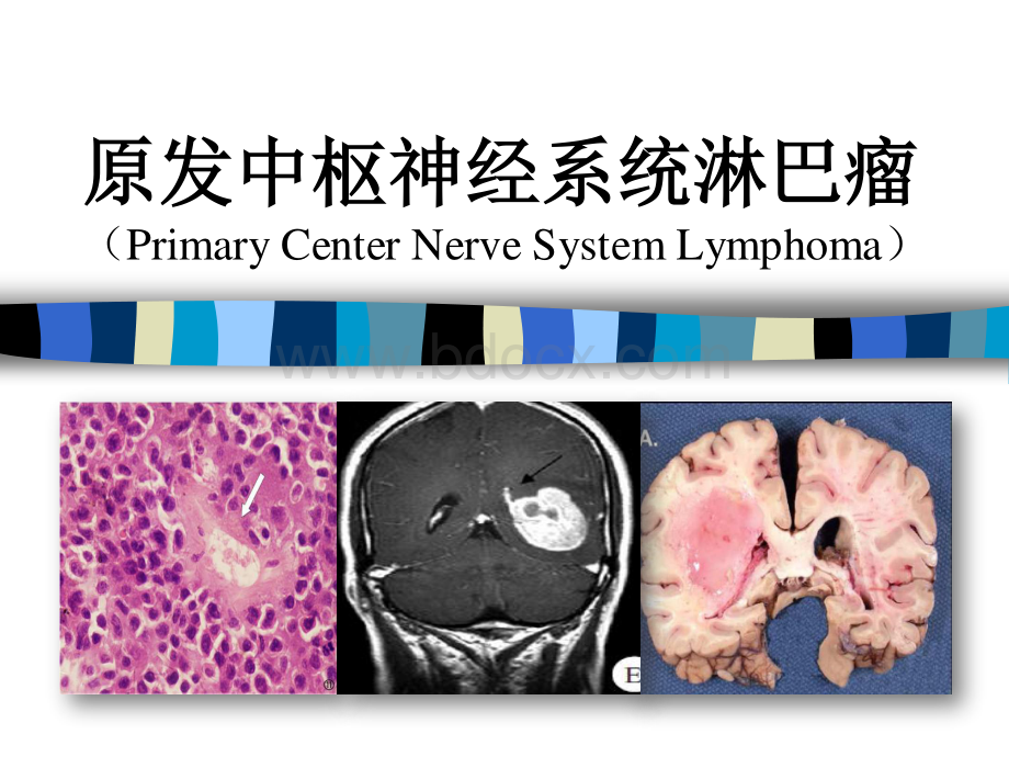 原发中枢神经系统淋巴瘤资料下载.pdf