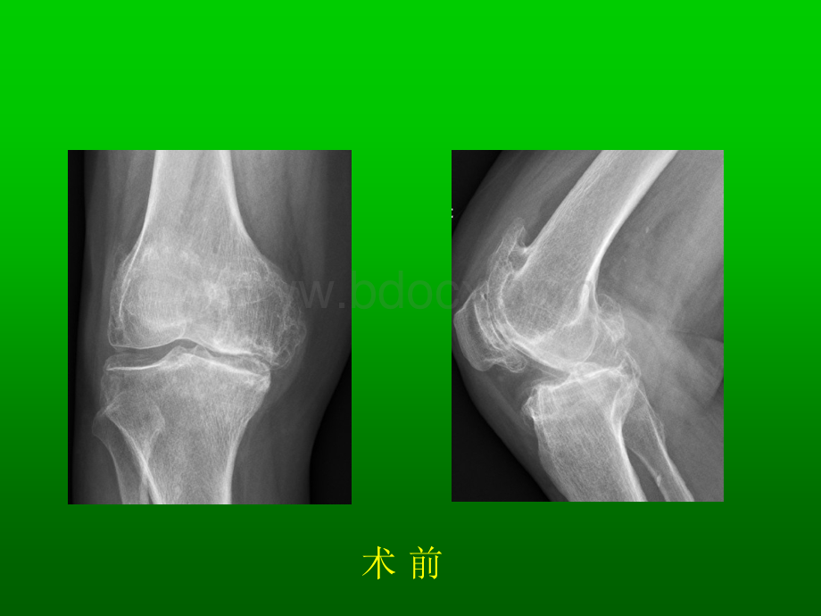 膝内翻畸形软组织平衡_精品文档PPT资料.ppt_第2页