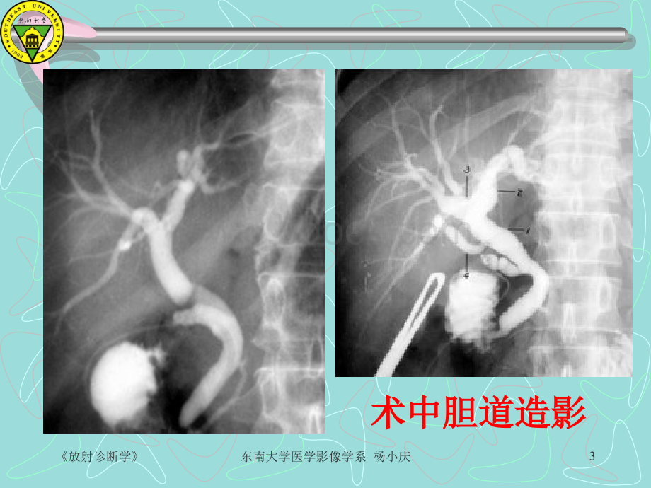 梗阻性黄疸的影像学诊断PPT推荐.ppt_第3页