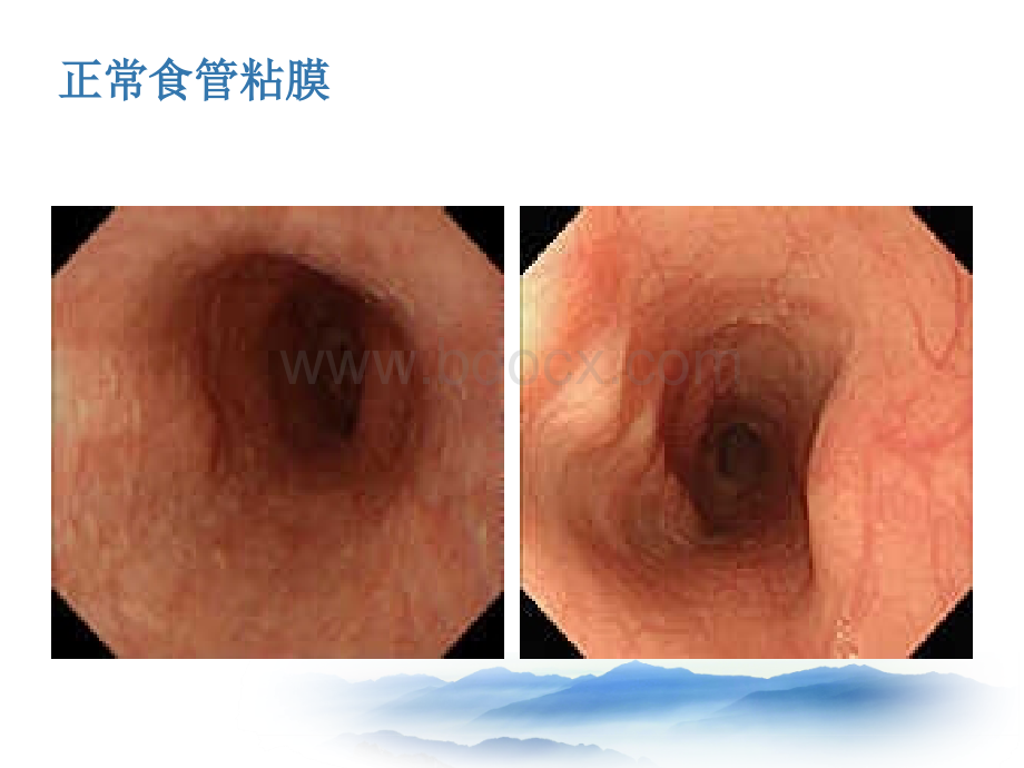 常见消化系统疾病的内镜诊断优质PPT.ppt_第3页