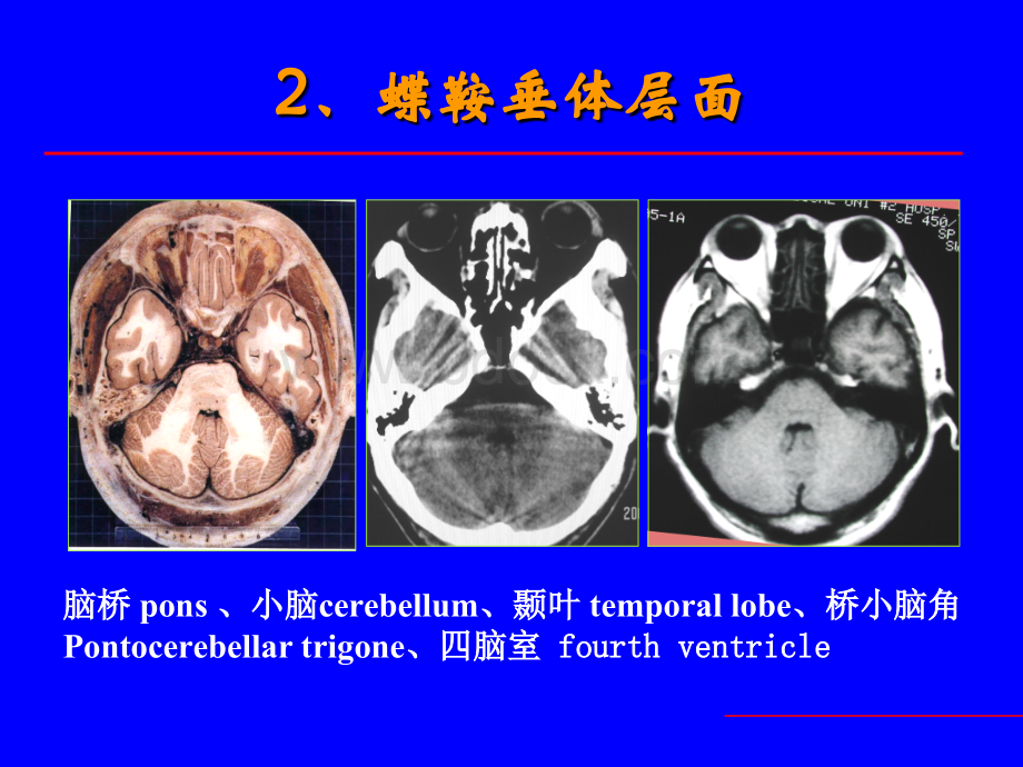 中枢神经系统疾病影像诊断PPT格式课件下载.ppt_第3页