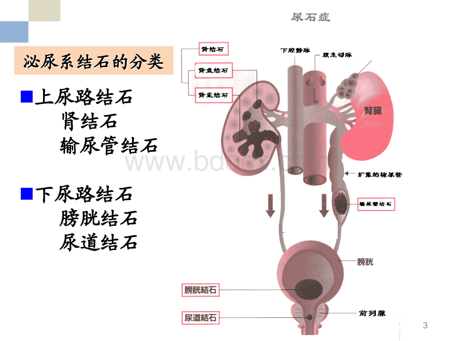 泌尿系结石的护理PPT推荐.ppt_第3页