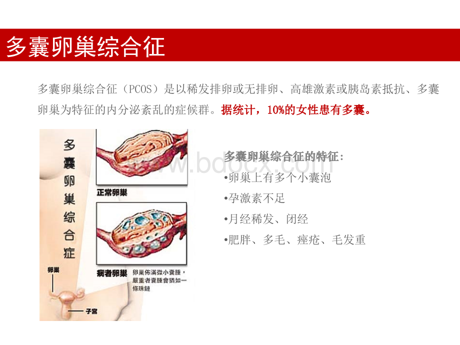 多囊卵巢综合征常见问题解答PPT资料.pptx