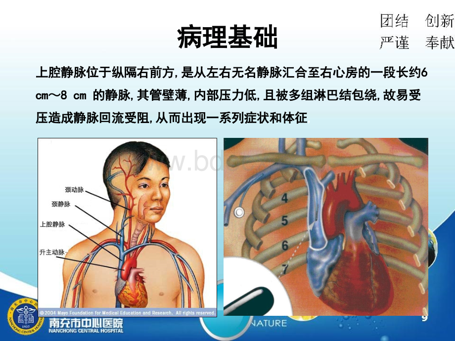 上腔静脉综合征护理查房.ppt_第3页