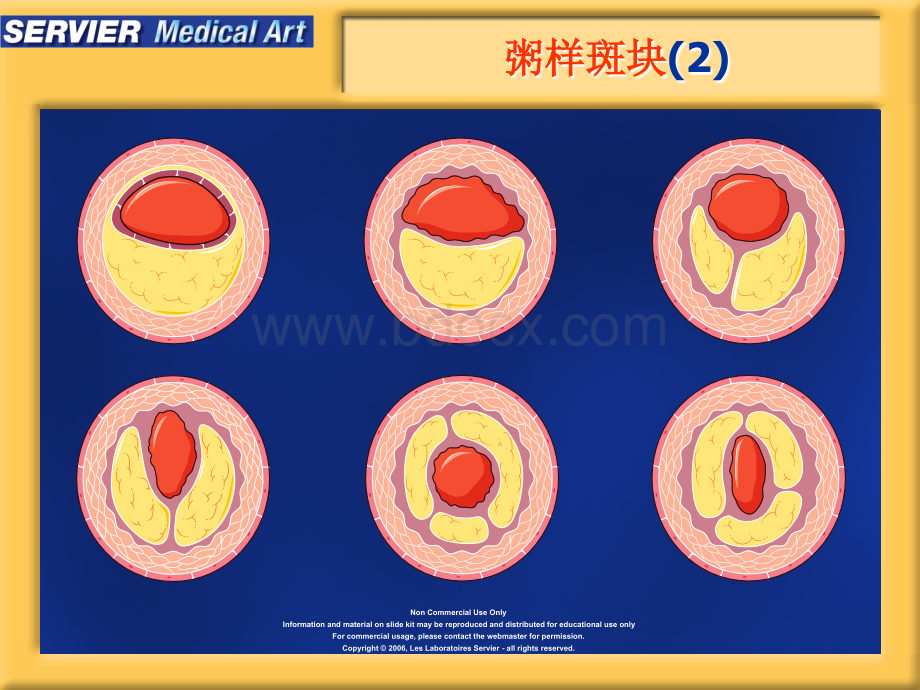 动脉粥样硬化精美图片PPT格式课件下载.ppt_第3页