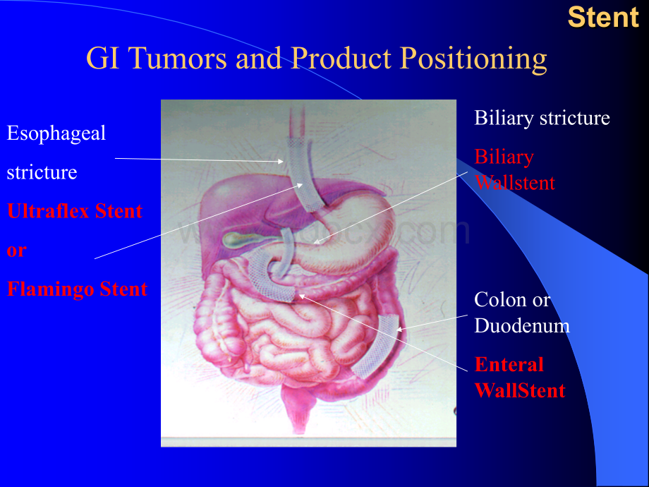 消化道金属支架的临床应用-宛新建优质PPT.ppt_第2页