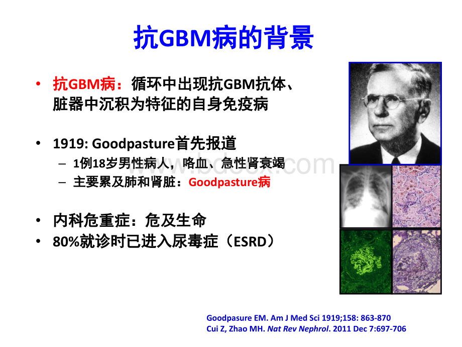 抗肾小球基底膜GBM病.ppt_第2页