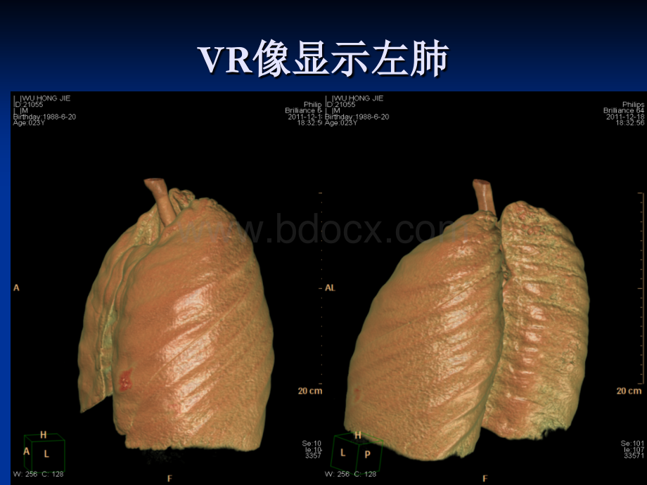 胸部解剖和常见疾病.ppt_第3页