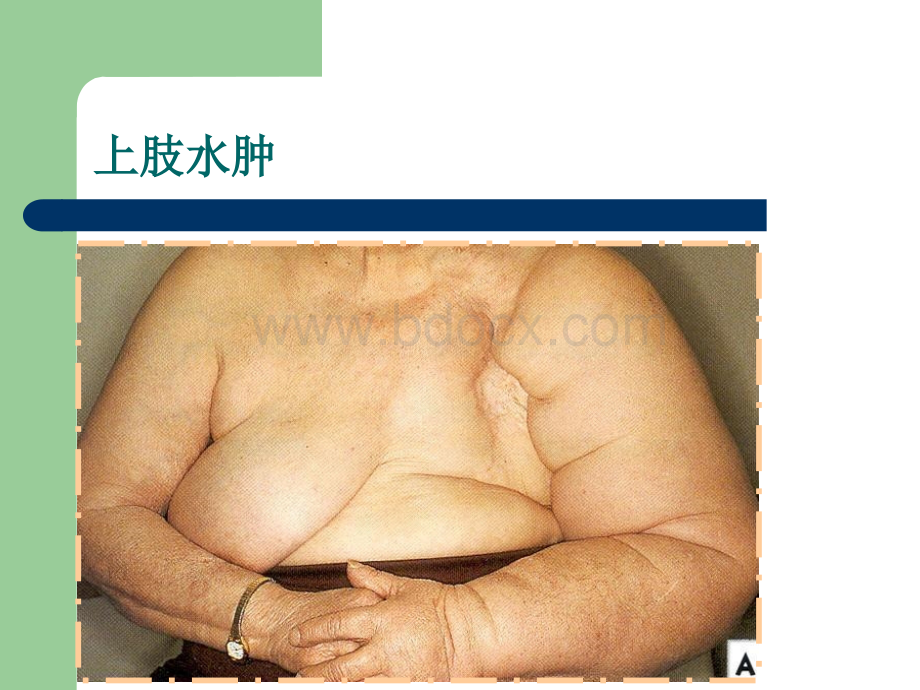 乳腺前哨淋巴结活检技术-乳腺外科的又一个里程碑PPT格式课件下载.ppt_第3页